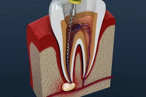 Как лечить пульпит зуба